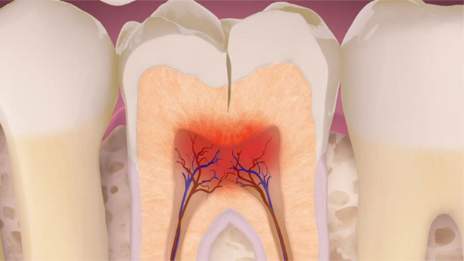 cracked teeth