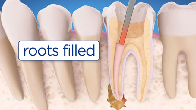 endodontic retreatment